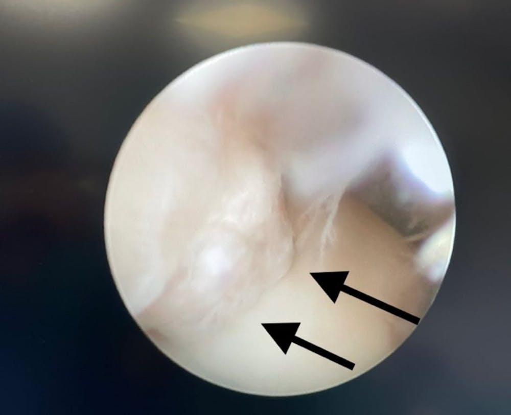 Οστεοχόνδρινες βλάβες αστραγάλου σε αθλητές, του Νίκου Δεσποτάκη runbeat.gr